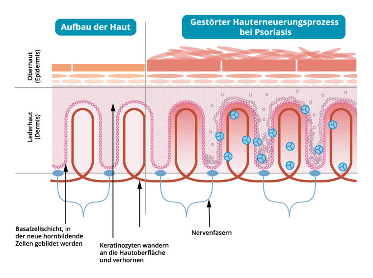 Die Grafik zeigt den Aufbau der Haut bei Schuppenflechte. 